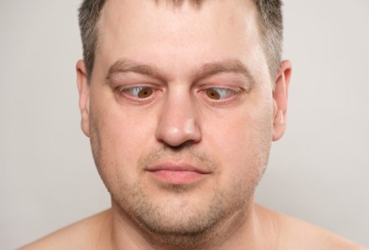 Strabismus1